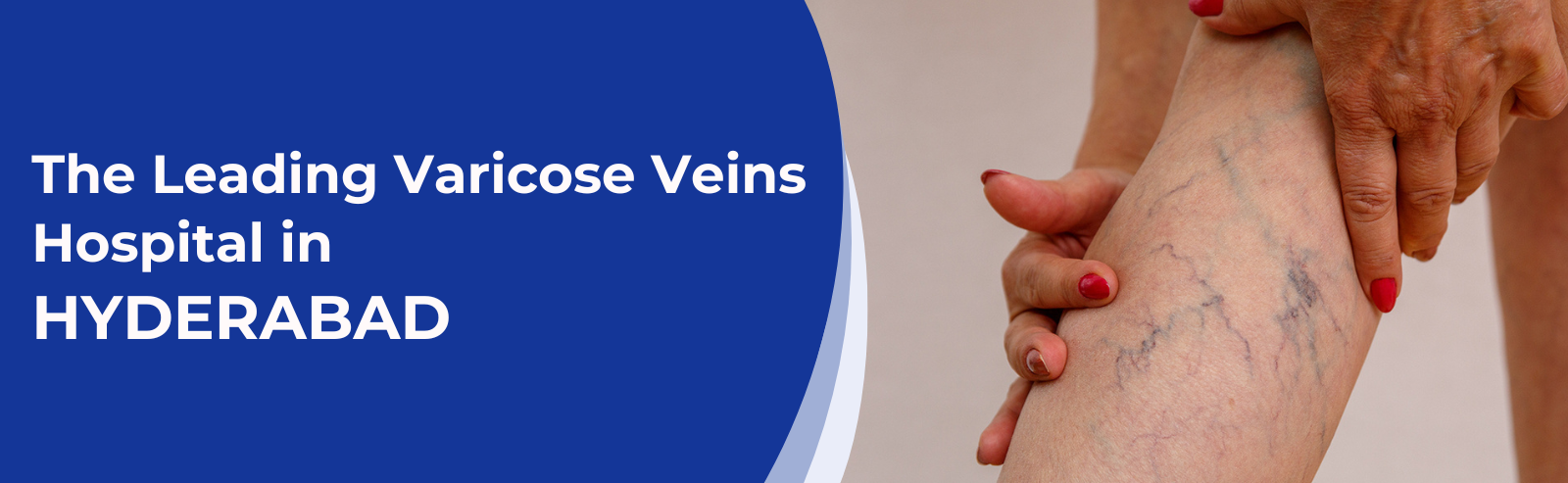 The Leading Varicose Veins Hospital in Hyderabad